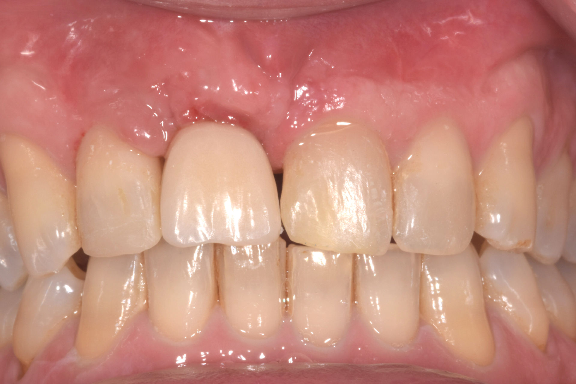 A provisional restoration was fabricated and delivered.