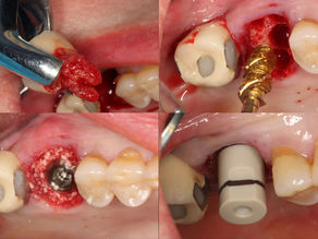 Digital Workflow for Immediate Implant Placement with 4-week Early Loading