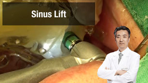 Delayed placement with VAROGuide, Crestal approach using VAROGuide Sinus kit #2