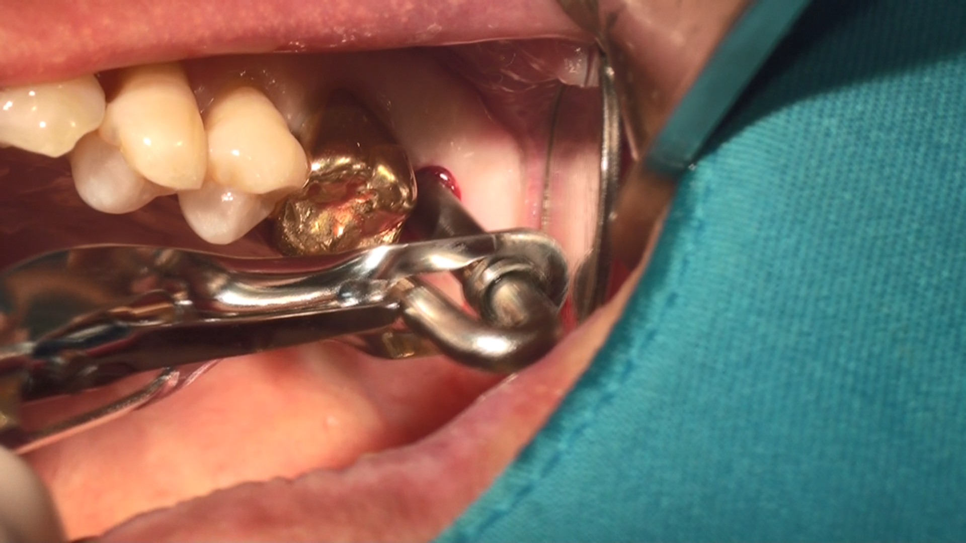 Fig 2. The bone graft was loaded into a bone carrier and inserted into the sinus