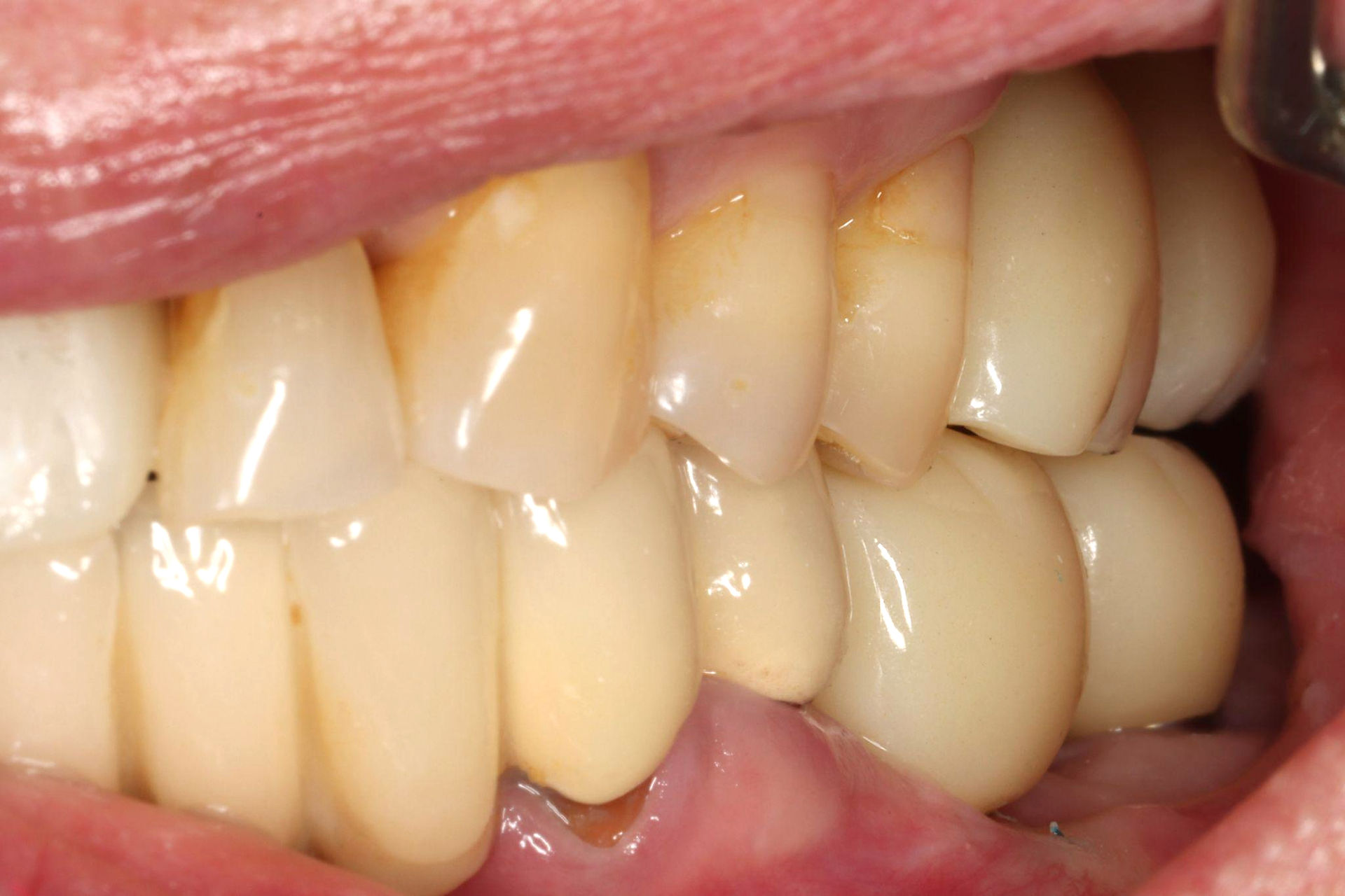 At the 1-month follow-up, the prosthesis remained stable, showing no complications.