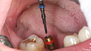 Removal of a fractured implant screw