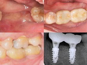 Early Loading of ALX-BT Implants in Different Bone Densities