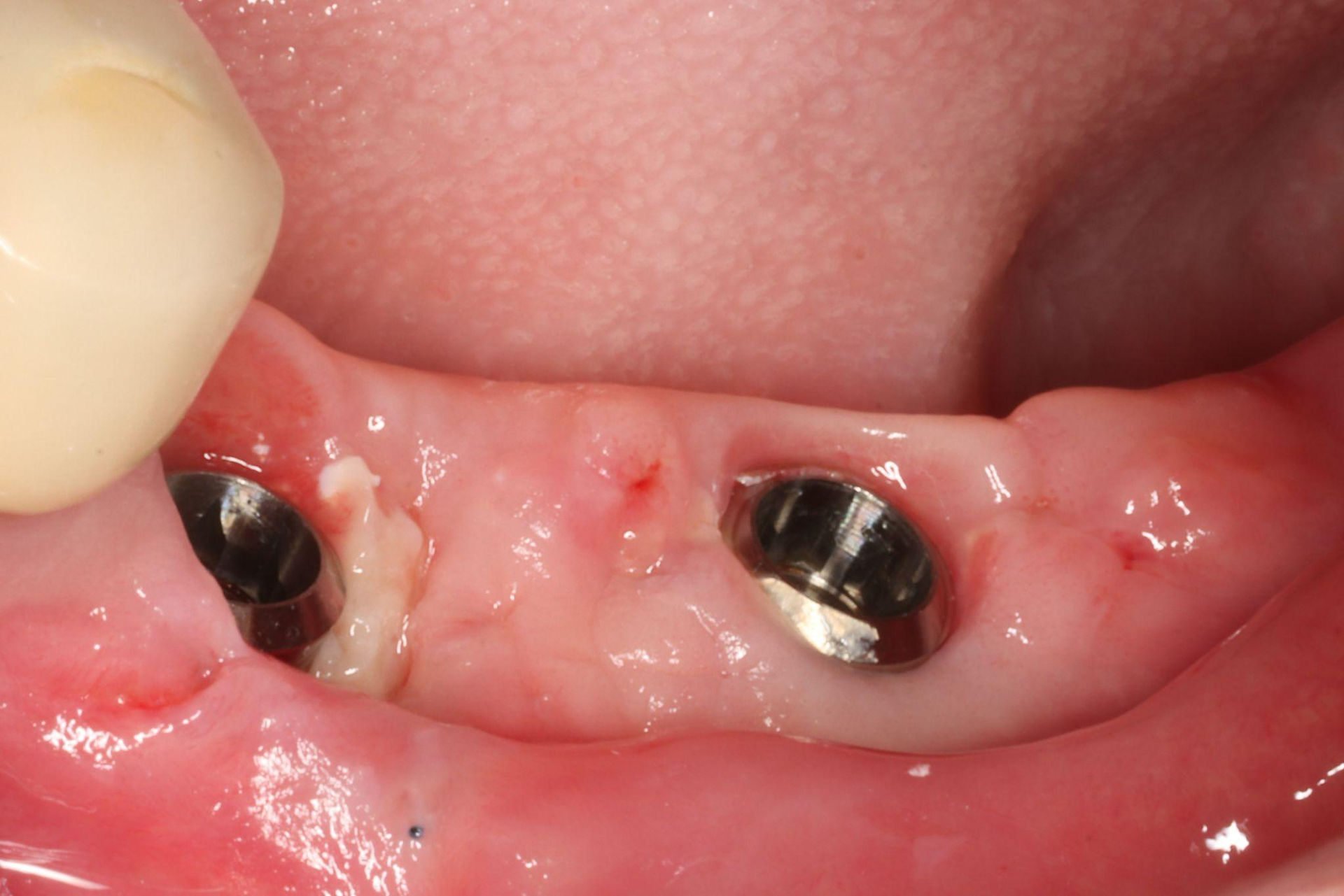 After two weeks, the soft tissue had healed, and sutures were removed.