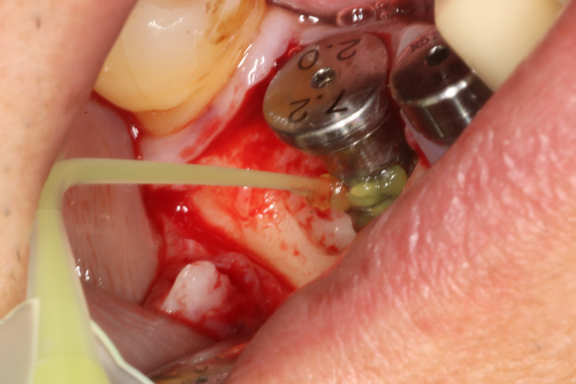 fig 5. The machined surface was treated with minocycline around the fixture and rinsed thoroughly with saline