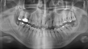 Immediate Placement in the maxillary anterior site