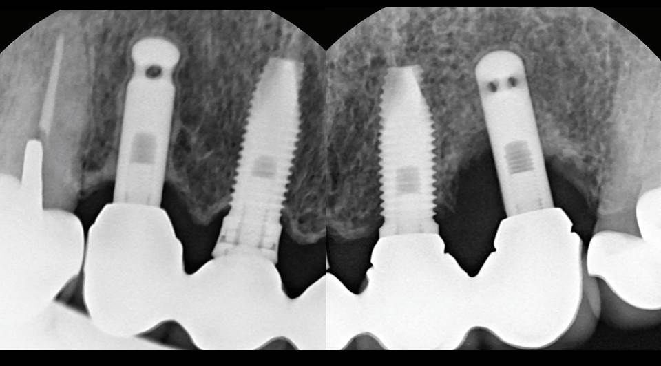 Peri-implantitis of #12 and #22
