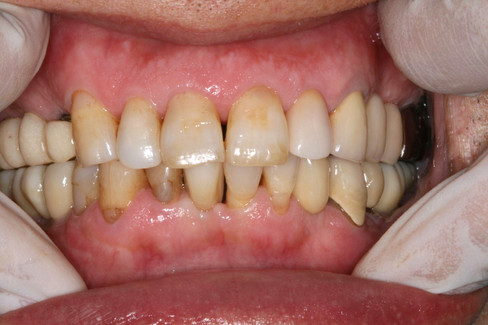 The final prosthetic restoration was delivered 5 months after surgery.