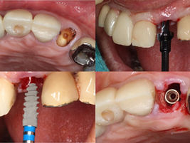 Immediate Placement of an ALX-BT Narrow Implant in the Maxillary Anterior Region