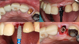 Immediate Placement of an ALX-BT Narrow Implant in the Maxillary Anterior Region