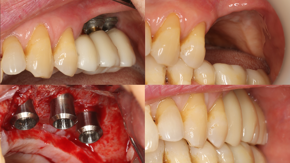 Re-implantation of Failing Implants Using ALX System and Final Restoration with CL-Link
