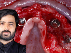 Acing the Atrophy. No Bone? No Problem!