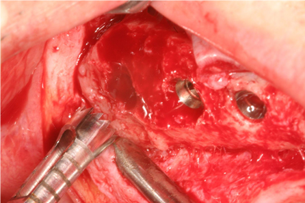 A trephine drill was used to harvest grafted bone from the third molar area (bone density: D3–2).