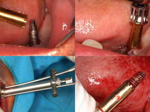 Simplified and Efficient Fixture Removal with the All-in-One Remover Kit