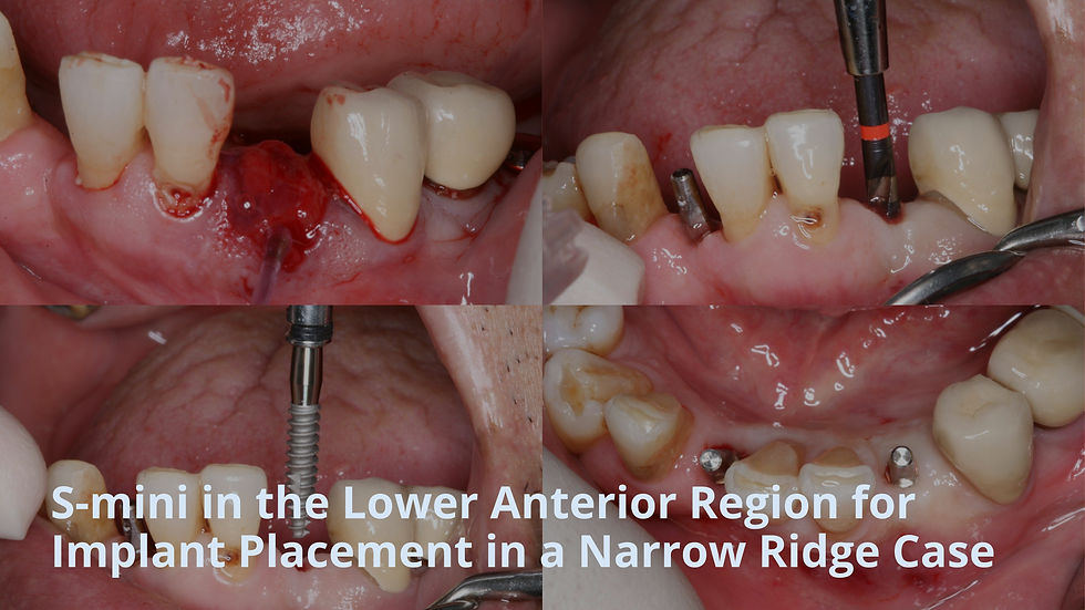 S-mini in the lower anterior region for implant placement in a narrow ridge