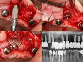 IS-II Implant Placement with Guided Bone Regeneration Using CTi-mem: A 13-Year Follow-Up Case