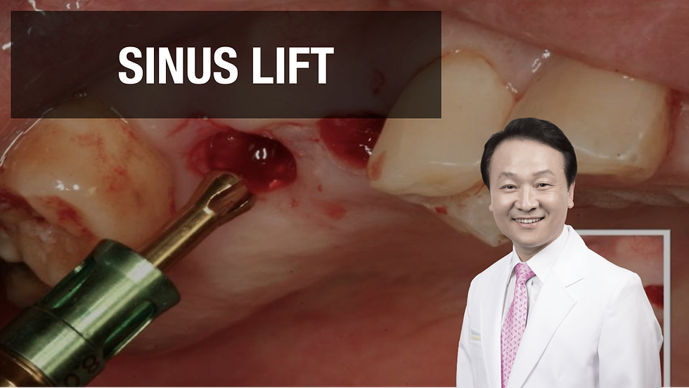 3-Year Follow up Results of Maxillary Multiple Teeth Replacement with IT-III active implants and the