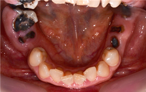 Mandibular occlusal view