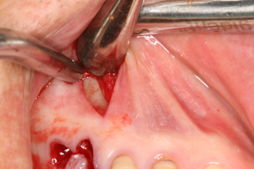 fig 1. A vertical incision was made on the mucosa around the apex of the 1st molar.
