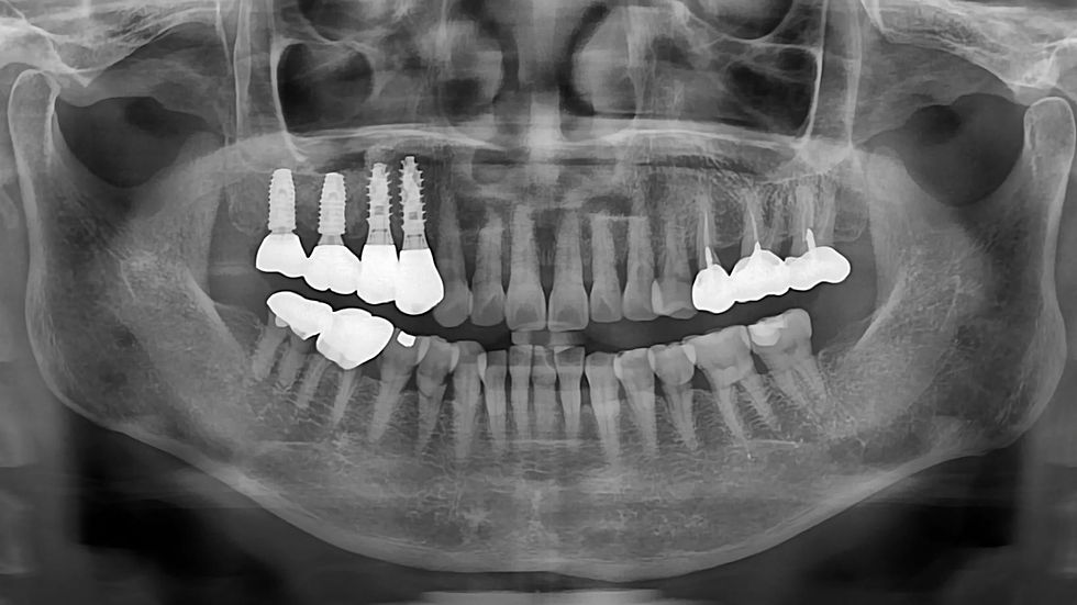 A final panoramic radiograph taken after delivery of the definitive restoration confirmed stable implant integration at sites #14 and #15.