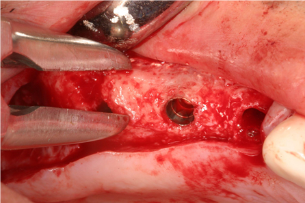 The lateral wall was completely filled with bone-like graft material, and an additional bone graft was performed at the apical area of implant #14 due to severe concavity.