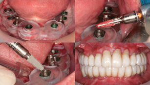 Long-term Success Over 7 Years After Full Arch Rehabilitation Using Neo NaviGuide