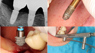 From Fixture Removal to ALX Same-Day Placement Using an All-in-One Remover Kit