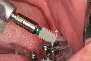 CMI IS-III Active 5.0*6.0m implant was placed in the area of #37.