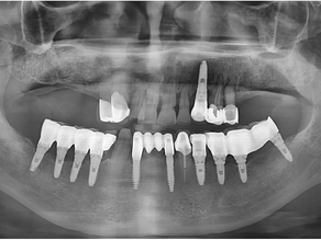 Implant placement with IT Wide Neck fixture in the Maxillary 1st Molar Area