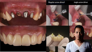 Aesthetic immediate implants placement with socket type 1 and angle screw channel driver modified for cement screw retain