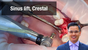 Indirect sinus lift with SCA kit