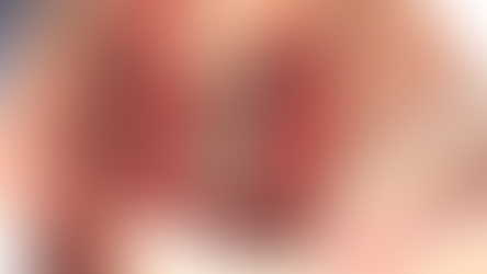 GBR with Neobiotech CTi-mem