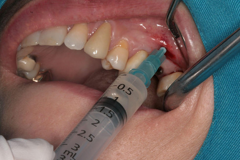 direct injection of a solution containing 1g of Ceftizoxime sodium (Ceftezole sodium) mixed with 1cc of sterile distilled water into the sinus cavity.