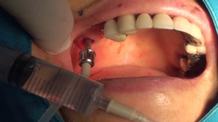 Crestal sinus elevation with SCA technique using Neo SinusAll kit