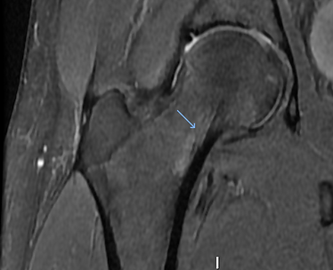 2021 R fem neck stress fx MRI 2.png