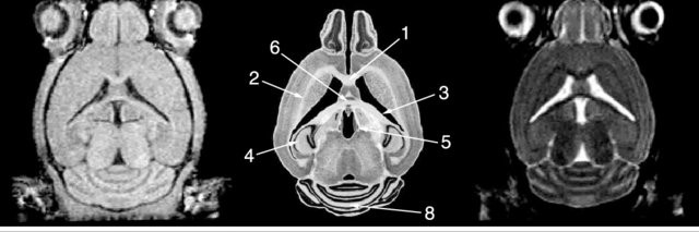 Left-T-1-weighted-and-right-T-2-weighted-high-resolution-3D-MRI-horizontal_Q640.jpg
