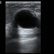 My New Friend THE CYST