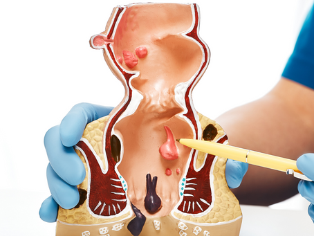 Restoring Reproductive Health: The Importance of Endometrial Polyp Removal