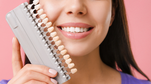 Considering Dental Veneers? Why Tijuana, Mexico Should Be Your Choice