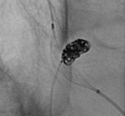 Partly Unsheathed Comaneci Support for Basilar Aneurysm Embolization