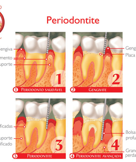 Periodontite.jpg