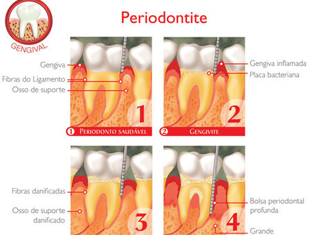 Periodontite - O que é e como tratar?