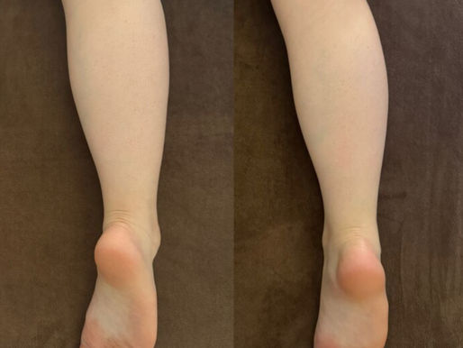 足の疲れケア。足裏の歪みやねじれを整え、歩行バランスを改善する施術のBefore／After写真。