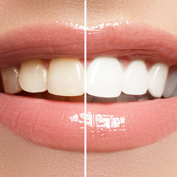 Before and after of professional teeth whitening.