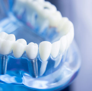 Model of dental implants.