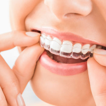 Woman placing in clear aligners.