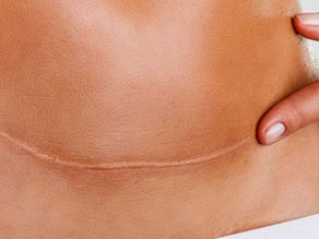 Microneedling: ReDerma — obnova kože nakon ožiljaka, strija i post-akni