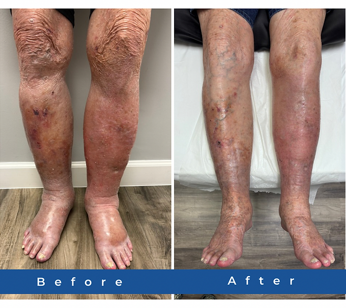 LTC B4 & After Legs.PNG