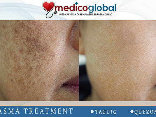 MELASMA LASER THERAPY