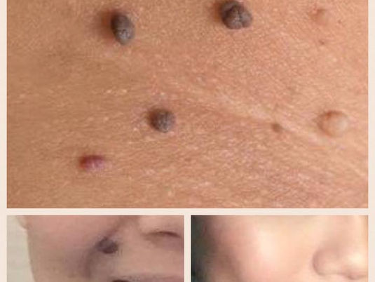 Mole Removal at Medico Global